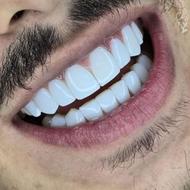 کامپوزیت و زیبایی