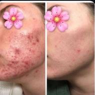 از بین برنده دائمی جوش لک پوستی