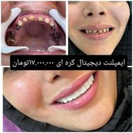 ایمپلنت دیجیتال با 30 درصد تخفیف و شرایط پرداخت ویژه (چک)