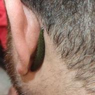 حجامت و زالو