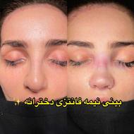 عمل بینی جراحی بینی