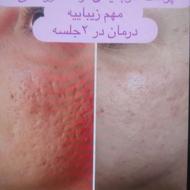 پلاسما جت و پلکسر رفع تمام نقص های صورت بوتاکس