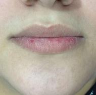 جوانسازی وزاویه سازی صورت باژل وبوتاکس