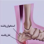 کلینیک تخصصی خار پاشنه