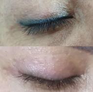 پاک کردن تتوی صورت