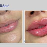 تزریق فیلر ژل بوتاکس فول فیس وزیربغل