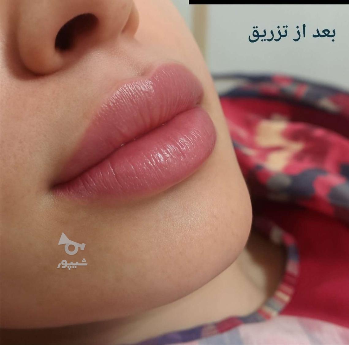 تخفیف بهاره فیلر لب