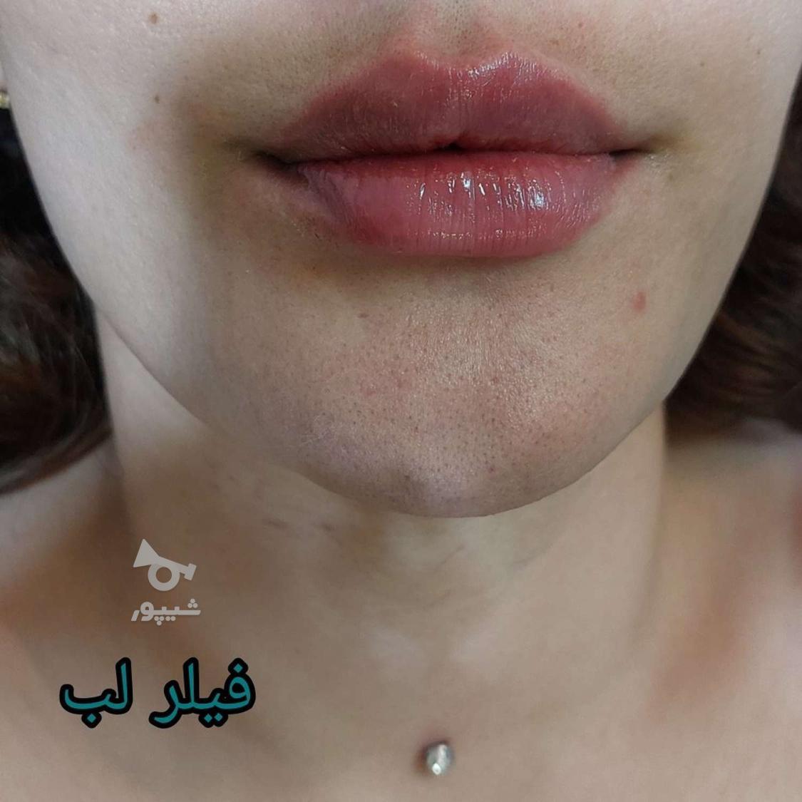 تخفیف بهاره فیلر لب