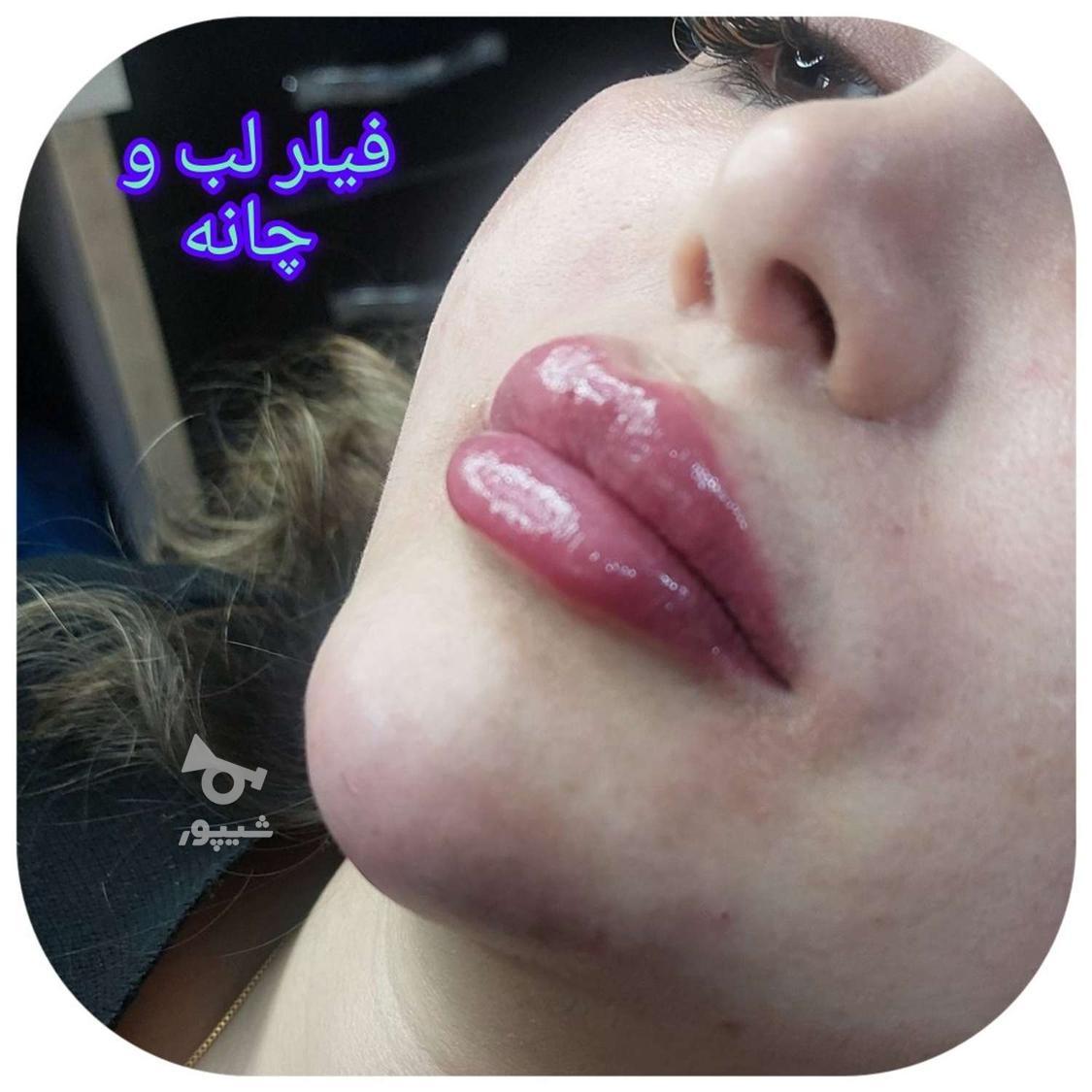 تخفیف بهاره فیلر لب