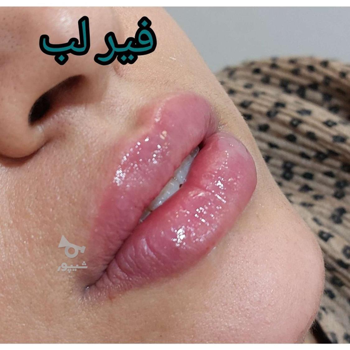 تخفیف بهاره فیلر لب