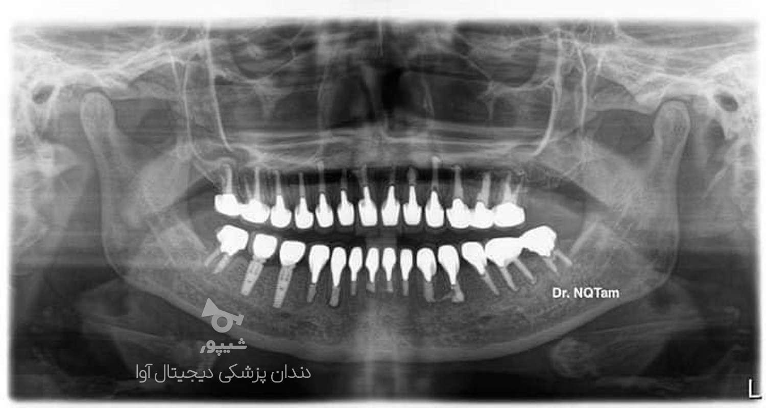 ایمپلنت دندانپزشکی آوا