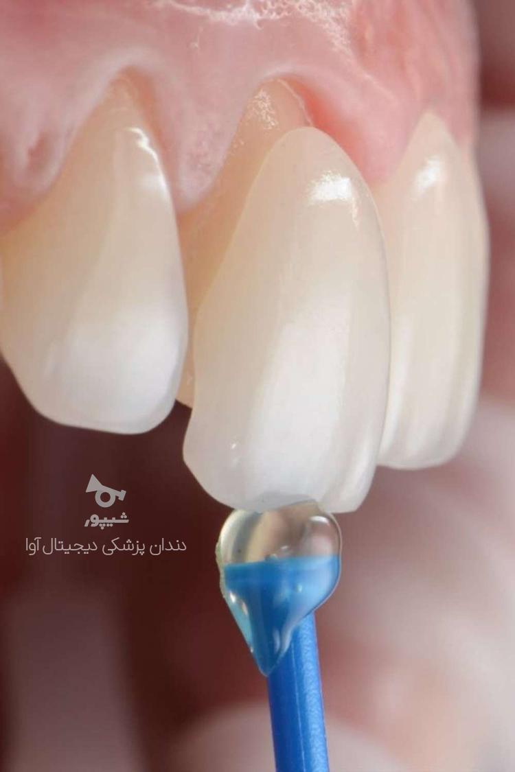 زیبایی دندان کامپوزیت آوا