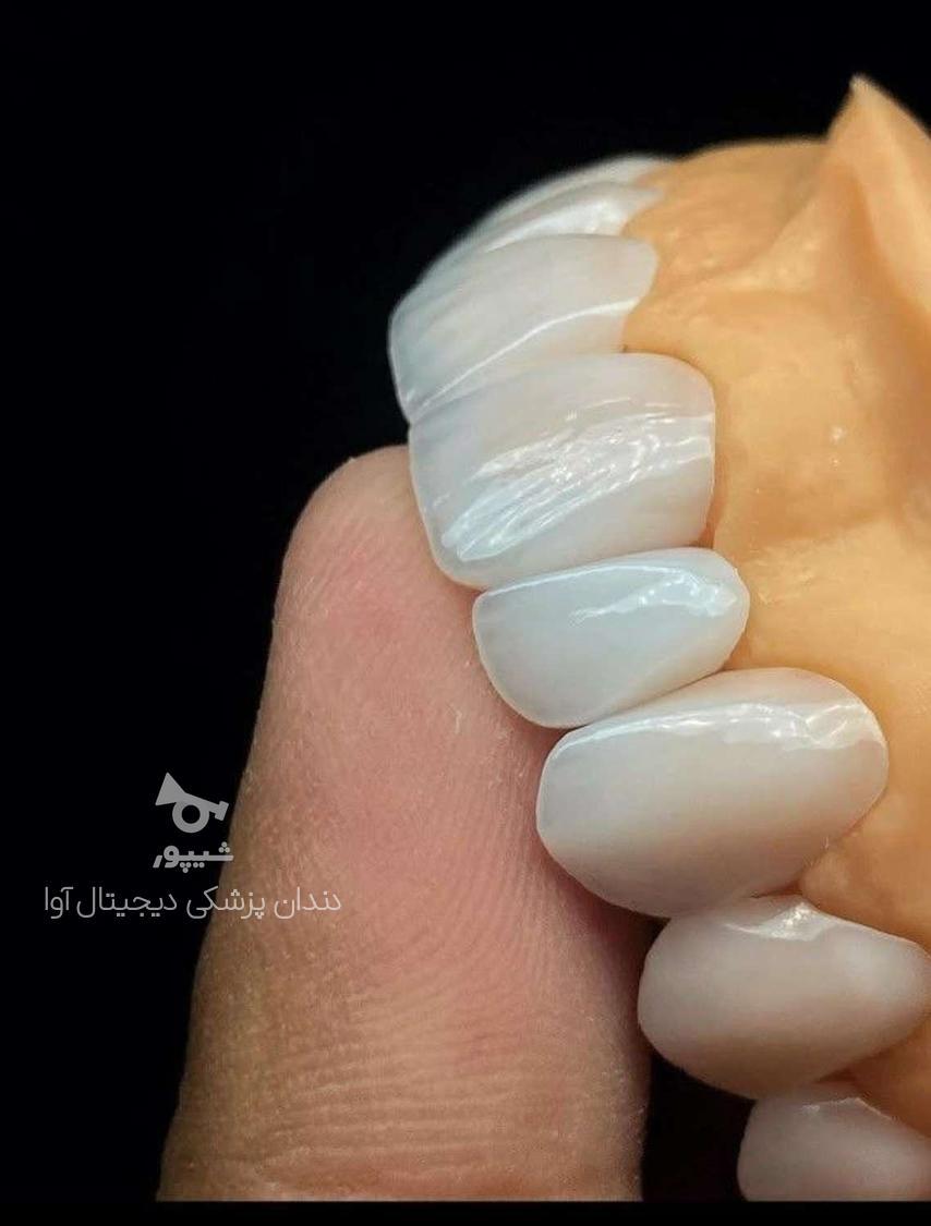 پروتز دندان آوا