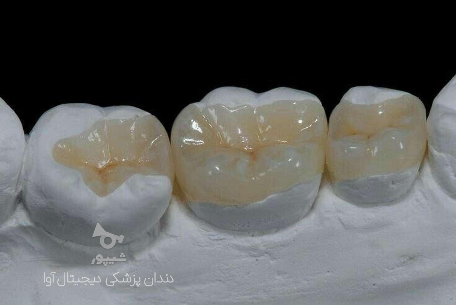پروتز دندان آوا