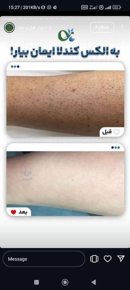 لیزر مو کندلا لیزر آقایان لیزر بانوان
