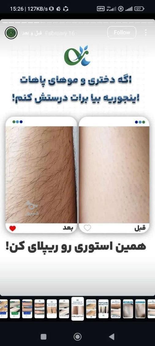 لیزر مو کندلا لیزر آقایان لیزر بانوان
