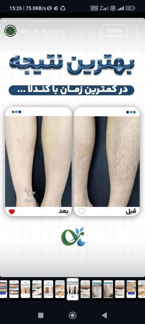 لیزر مو کندلا لیزر آقایان لیزر بانوان