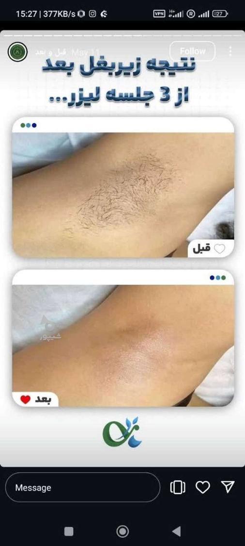 لیزر مو کندلا لیزر آقایان لیزر بانوان