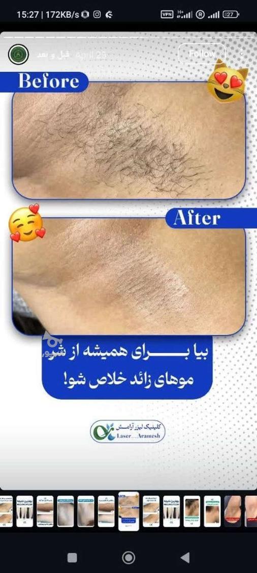 لیزر مو کندلا لیزر آقایان لیزر بانوان