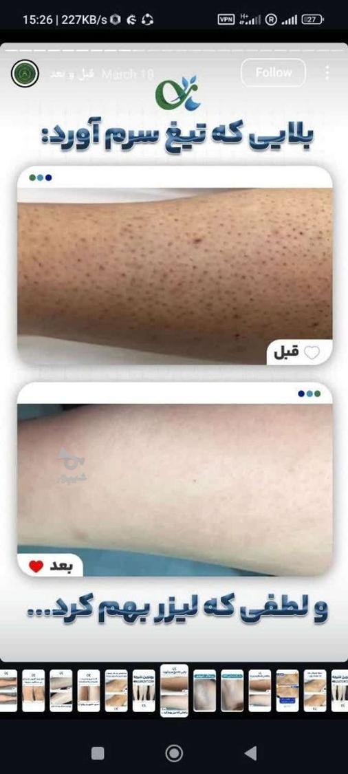 لیزر مو کندلا لیزر آقایان لیزر بانوان
