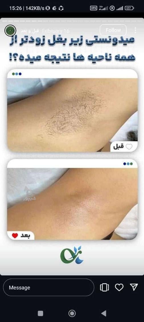 لیزر مو کندلا لیزر آقایان لیزر بانوان