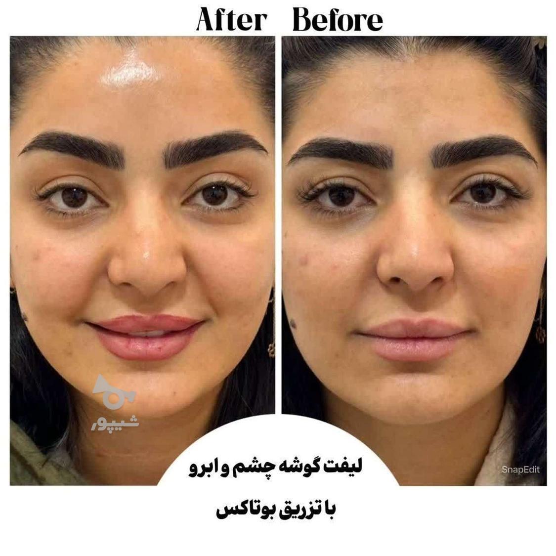 فیلر زیر چشم بوتاکس چشم گربه ای فیلر بادی ژل لب نخ لیفت ابرو
