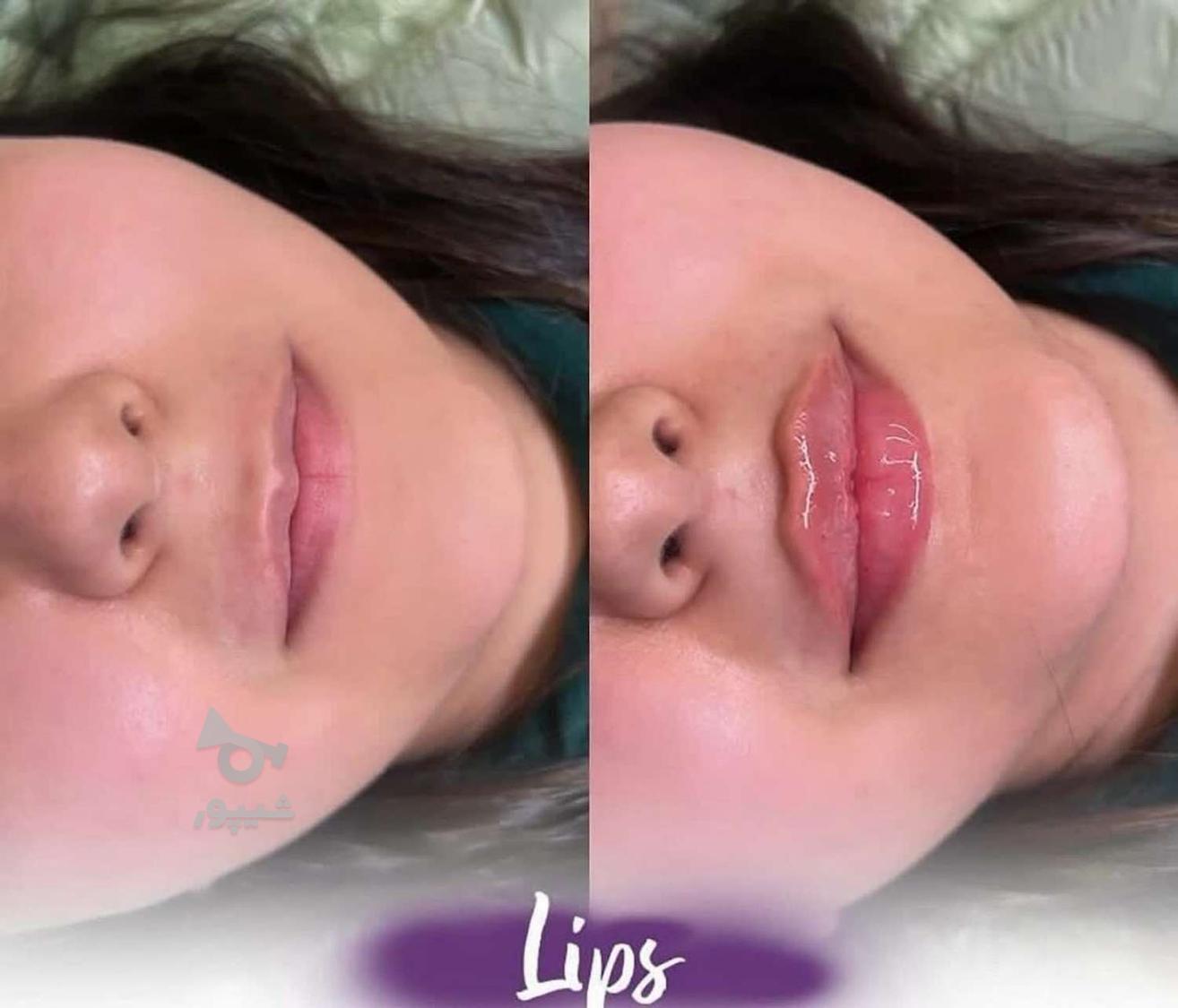 فیلر زیر چشم بوتاکس چشم گربه ای فیلر بادی ژل لب نخ لیفت ابرو
