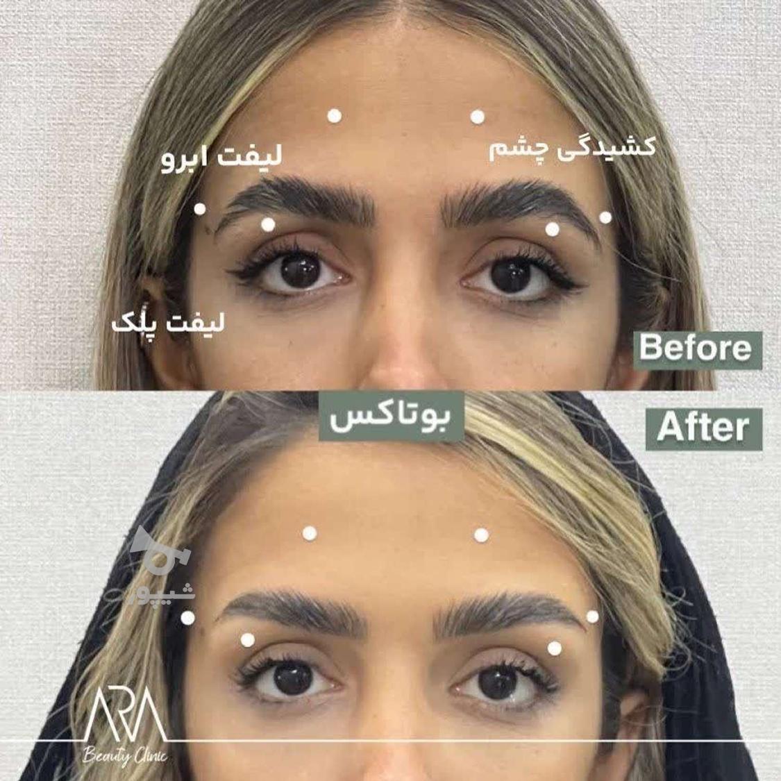 فیلر زیر چشم بوتاکس چشم گربه ای فیلر بادی ژل لب نخ لیفت ابرو
