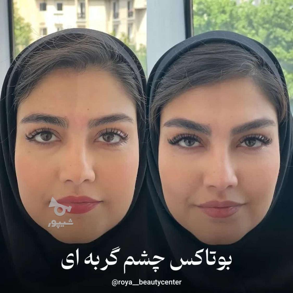 فیلر زیر چشم بوتاکس چشم گربه ای فیلر بادی ژل لب نخ لیفت ابرو