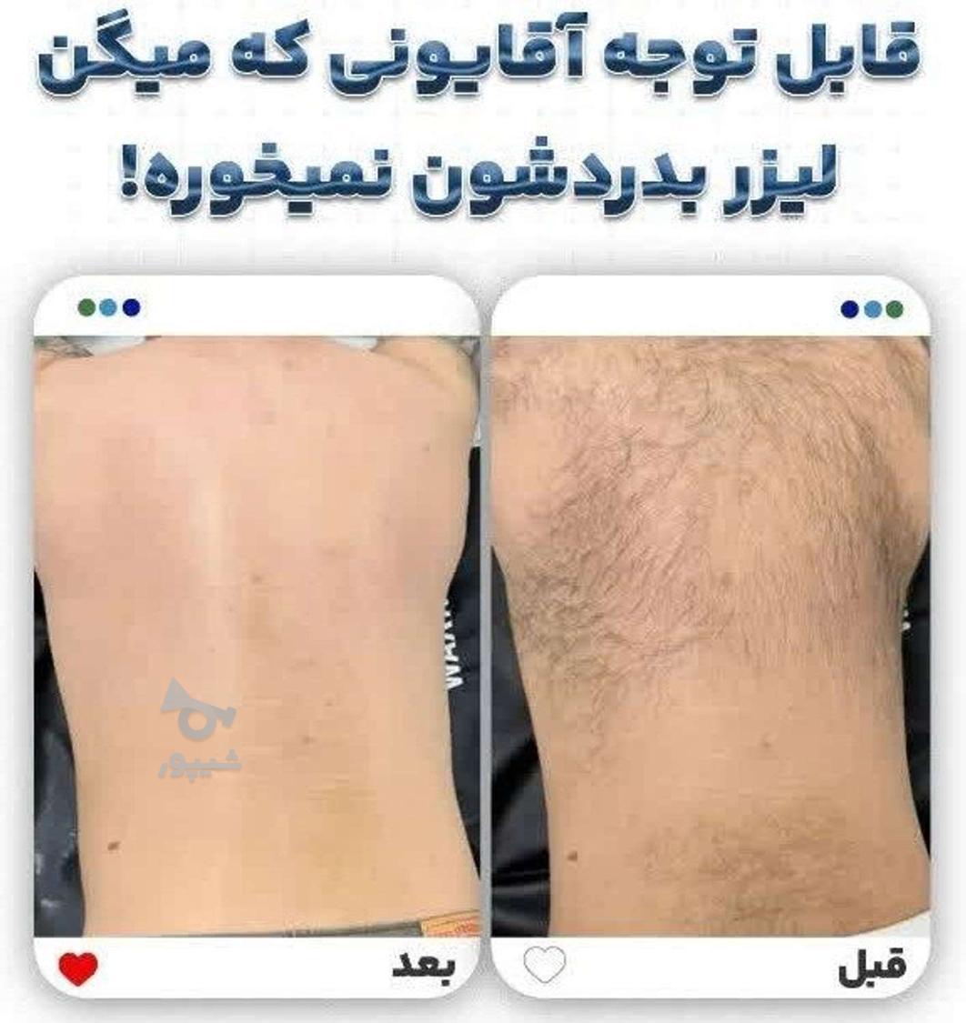 لیزر موی زائد لیزر طول موج کندلا لیزر آقایان لیزر بانوان