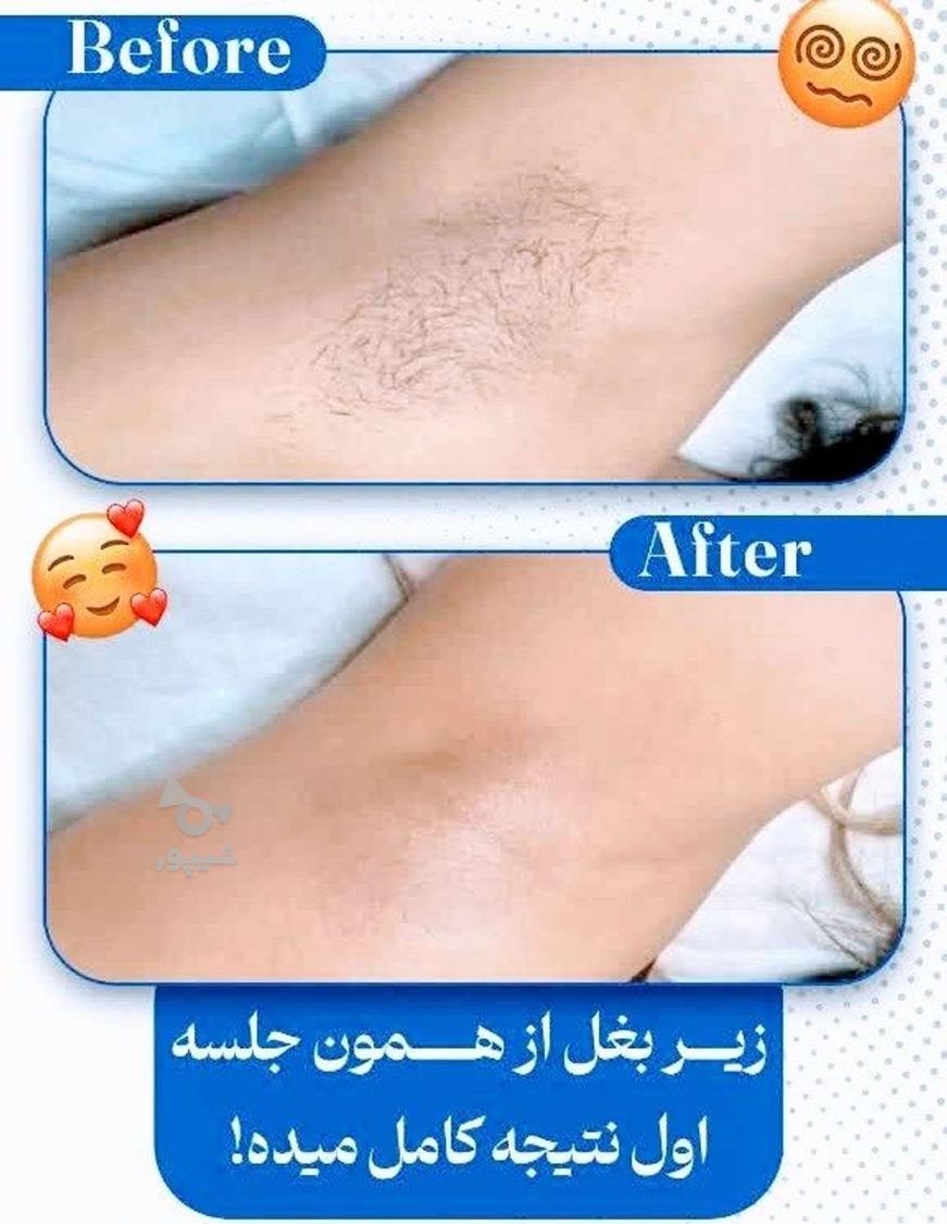 لیزر موی زائد لیزر طول موج کندلا لیزر آقایان لیزر بانوان