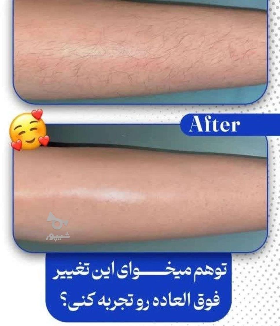 لیزر موی زائد لیزر طول موج کندلا لیزر آقایان لیزر بانوان