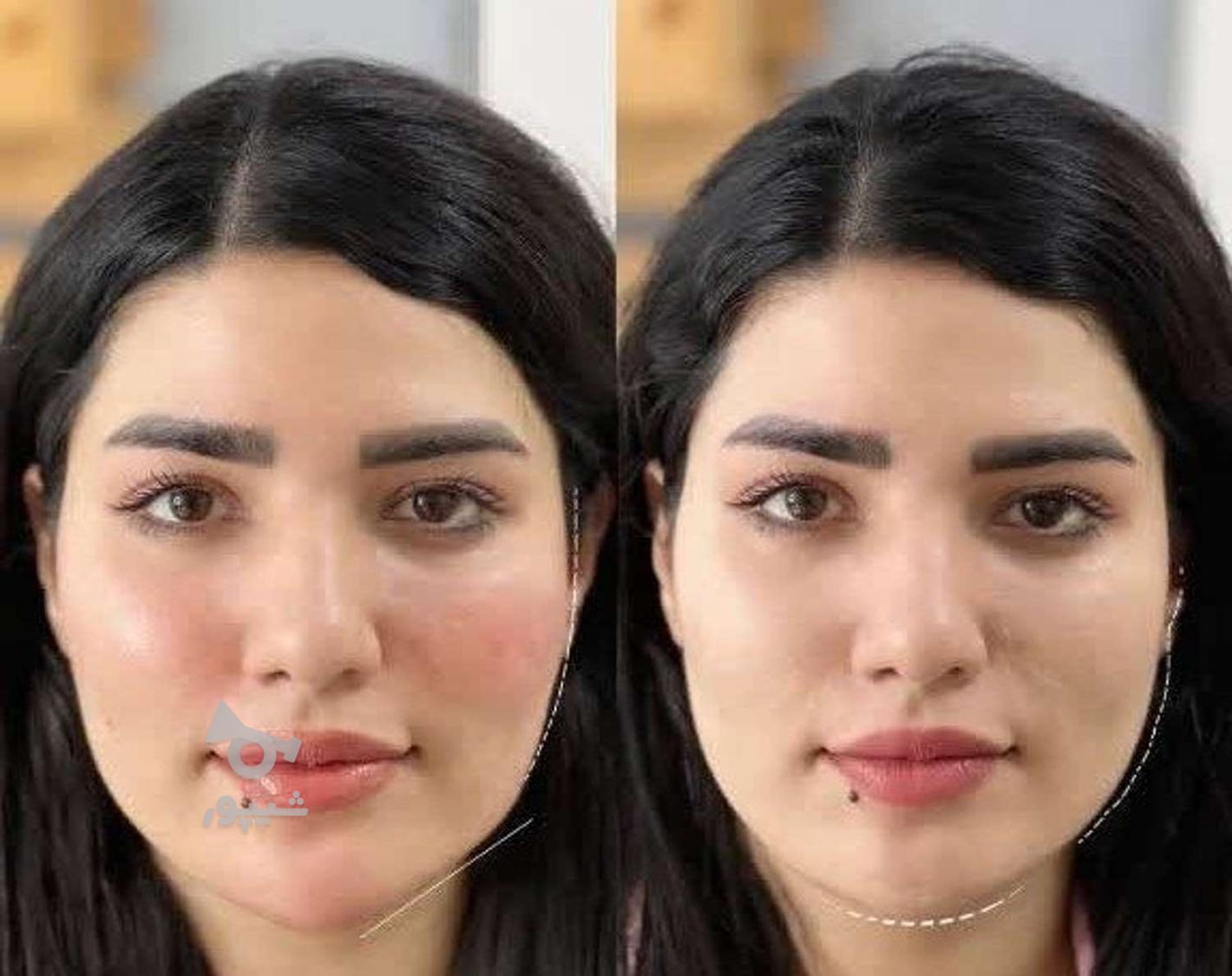 فیلر بادی فیلر ژل لب نخ لیفت شقیقه بوتاکس آنزیم لب