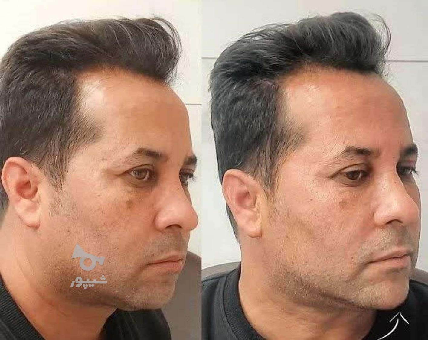 فیلر بادی فیلر ژل لب نخ لیفت شقیقه بوتاکس آنزیم لب