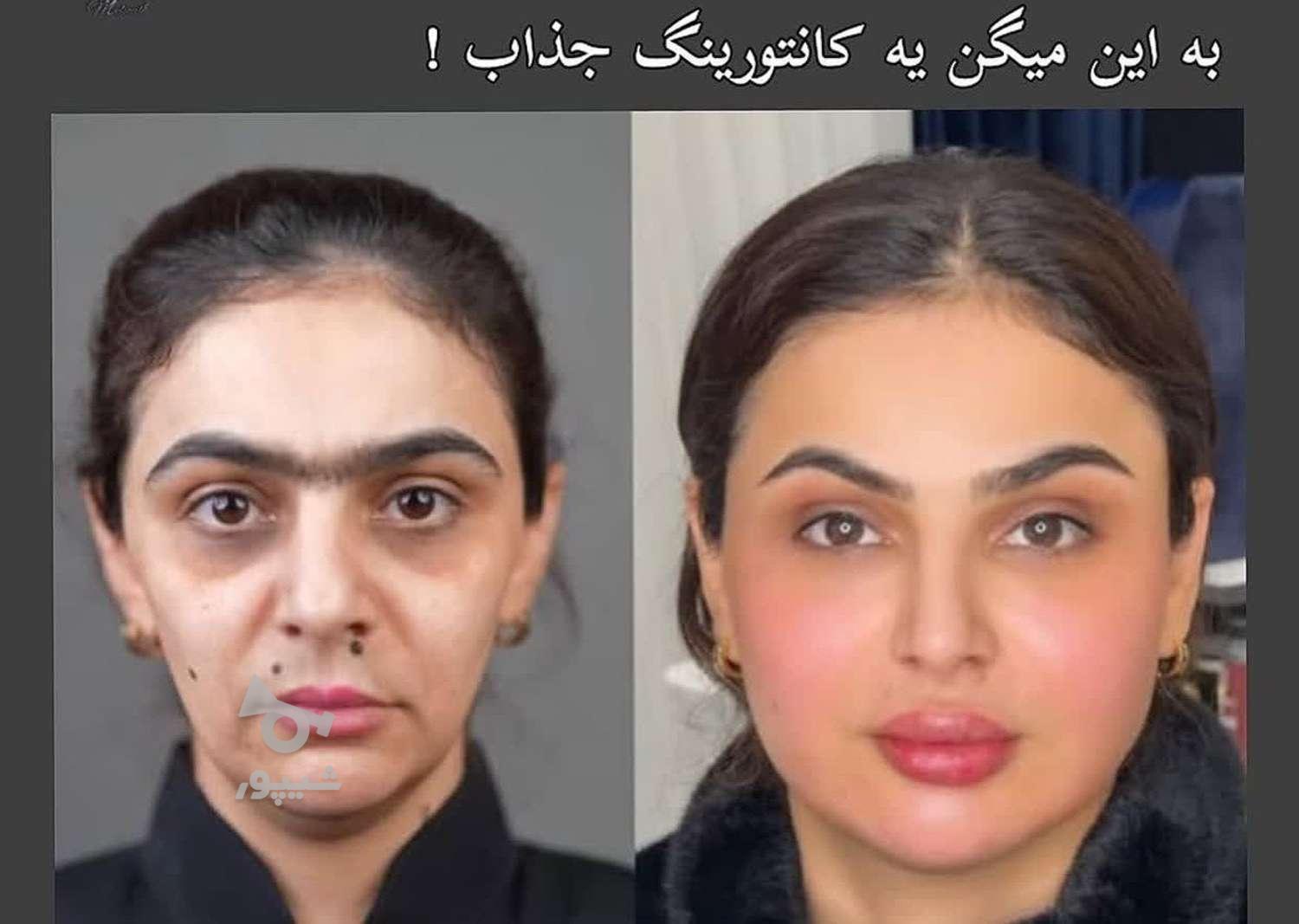 فیلر بادی فیلر ژل لب نخ لیفت شقیقه بوتاکس آنزیم لب