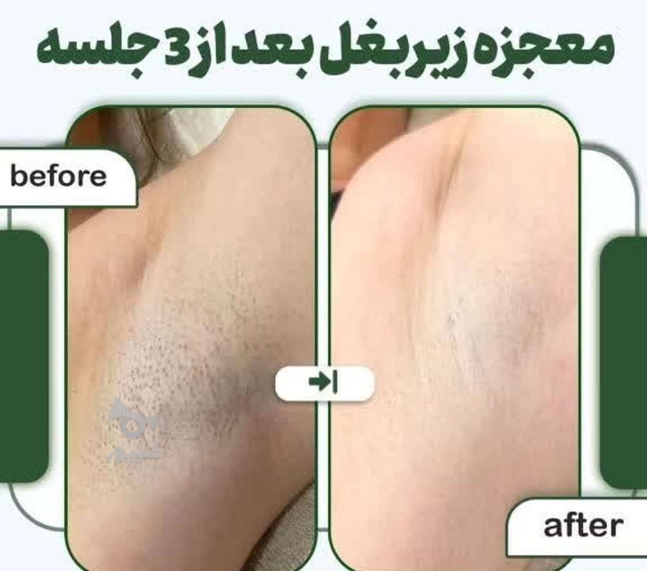 لیزر طول موج کندلا لیزر آقایان لیزر بانوان لیز کلاریتی