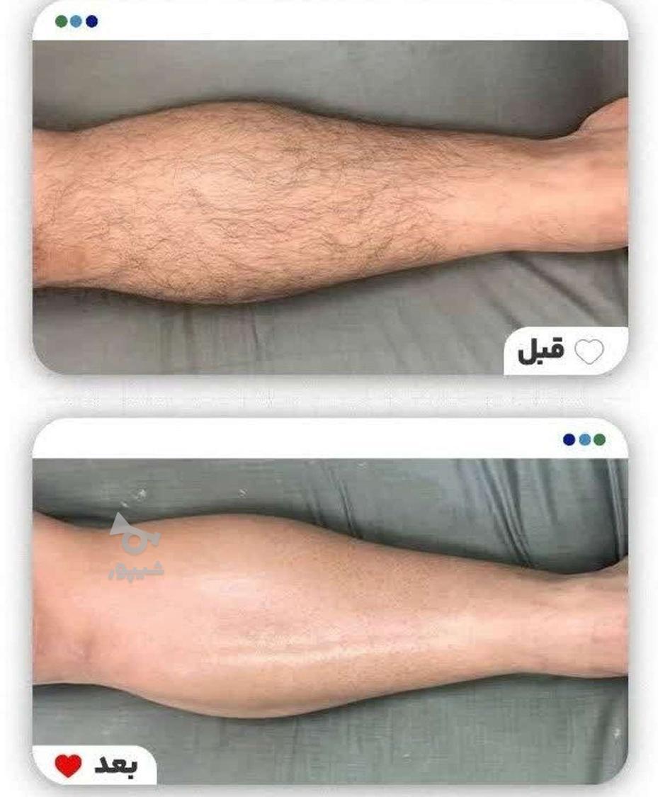 لیزر طول موج کندلا لیزر آقایان لیزر بانوان لیز کلاریتی