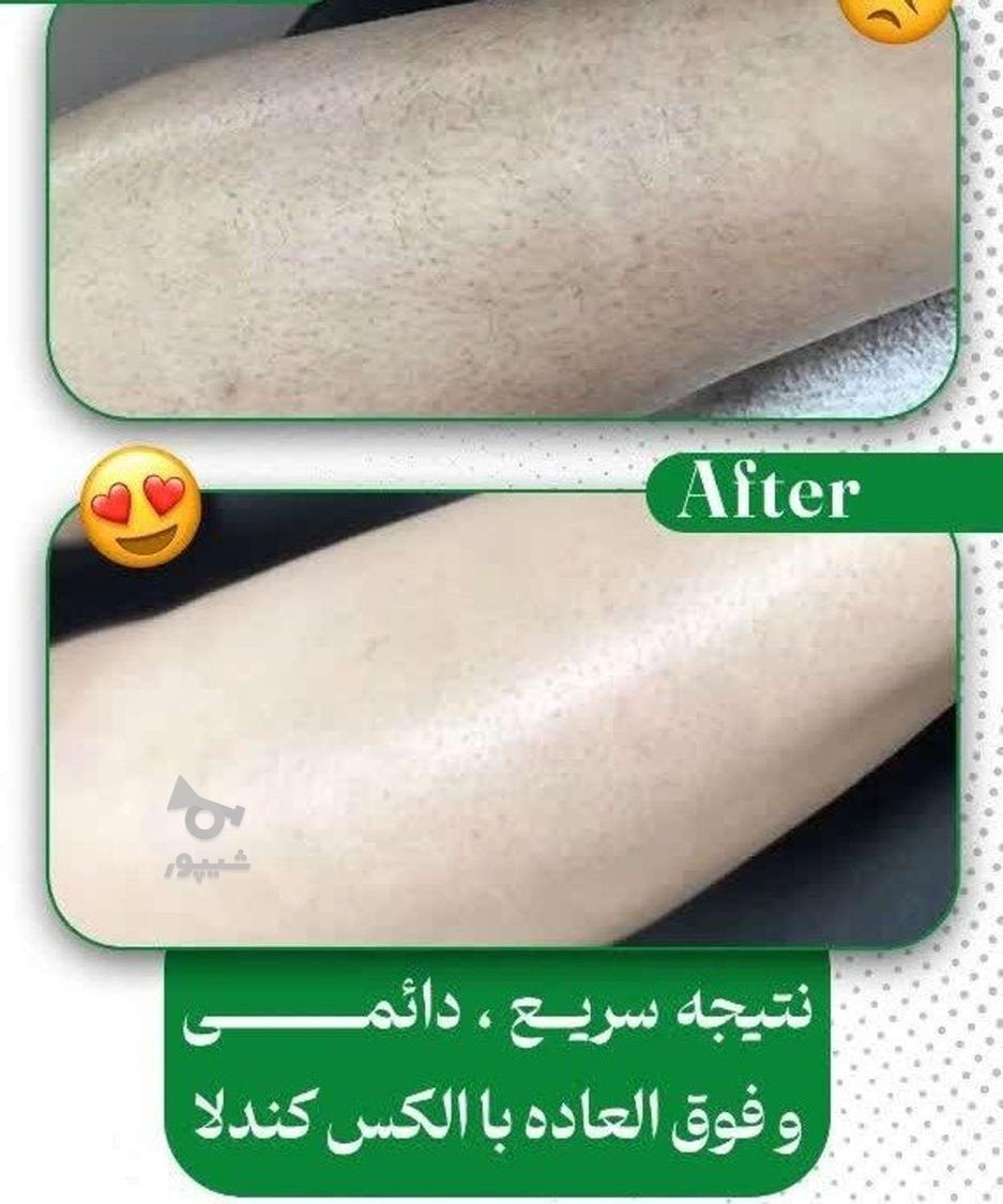 لیزر طول موج کندلا لیزر آقایان لیزر بانوان لیز کلاریتی
