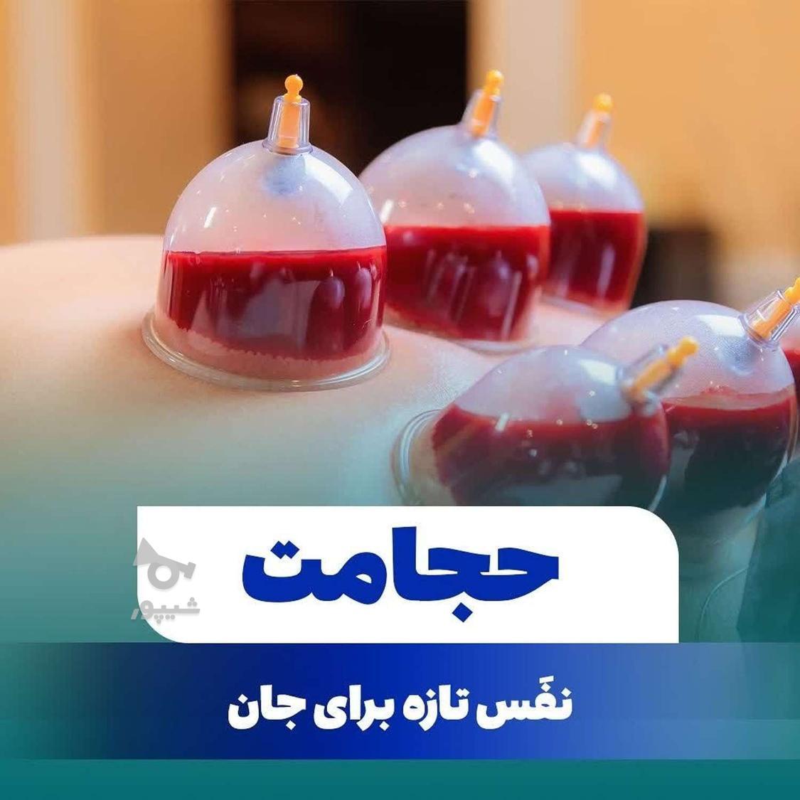 زالو درمانی فصد خون طب سوزنی امبدینگ حجامت بادکش گرم