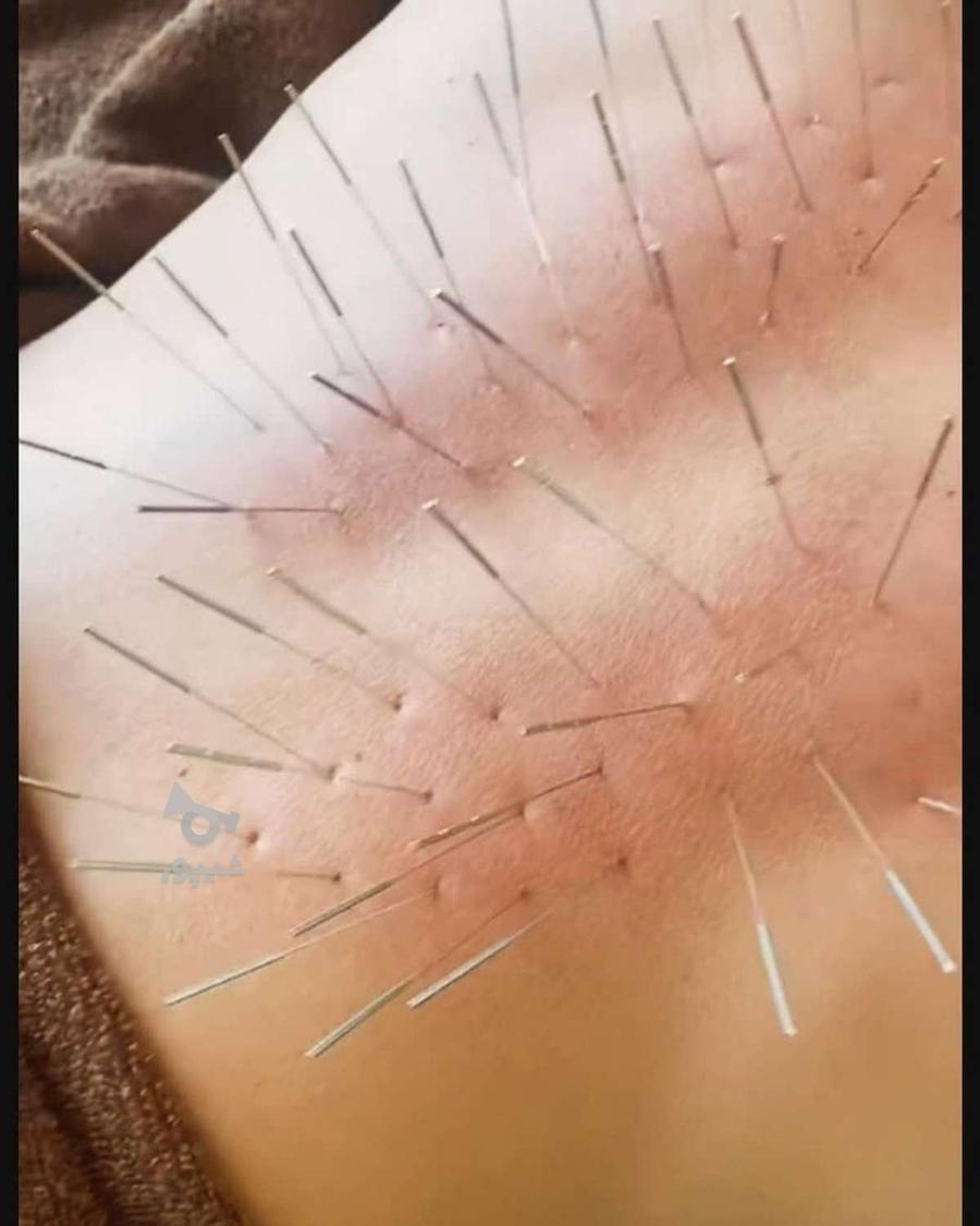 زالو درمانی فصد خون طب سوزنی امبدینگ حجامت بادکش گرم