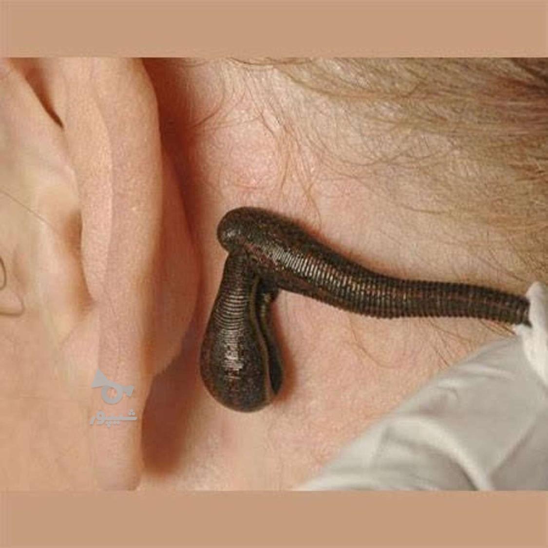 زالو درمانی فصد خون طب سوزنی امبدینگ حجامت بادکش گرم