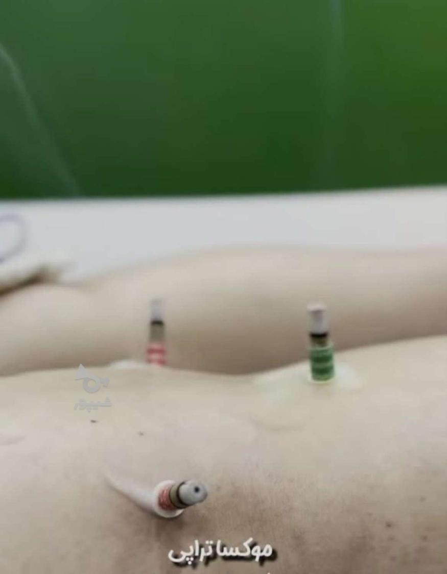 زالو درمانی فصد خون طب سوزنی امبدینگ حجامت بادکش گرم