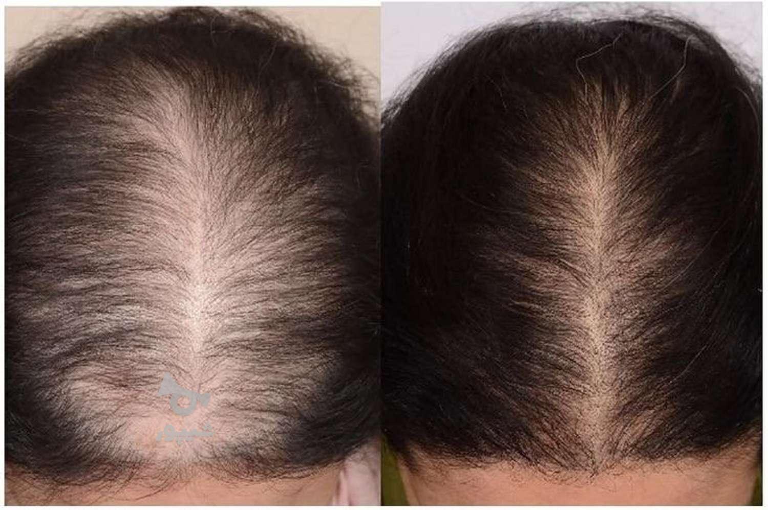 فرصت طلایی آفر ویژه اسکالپ سر