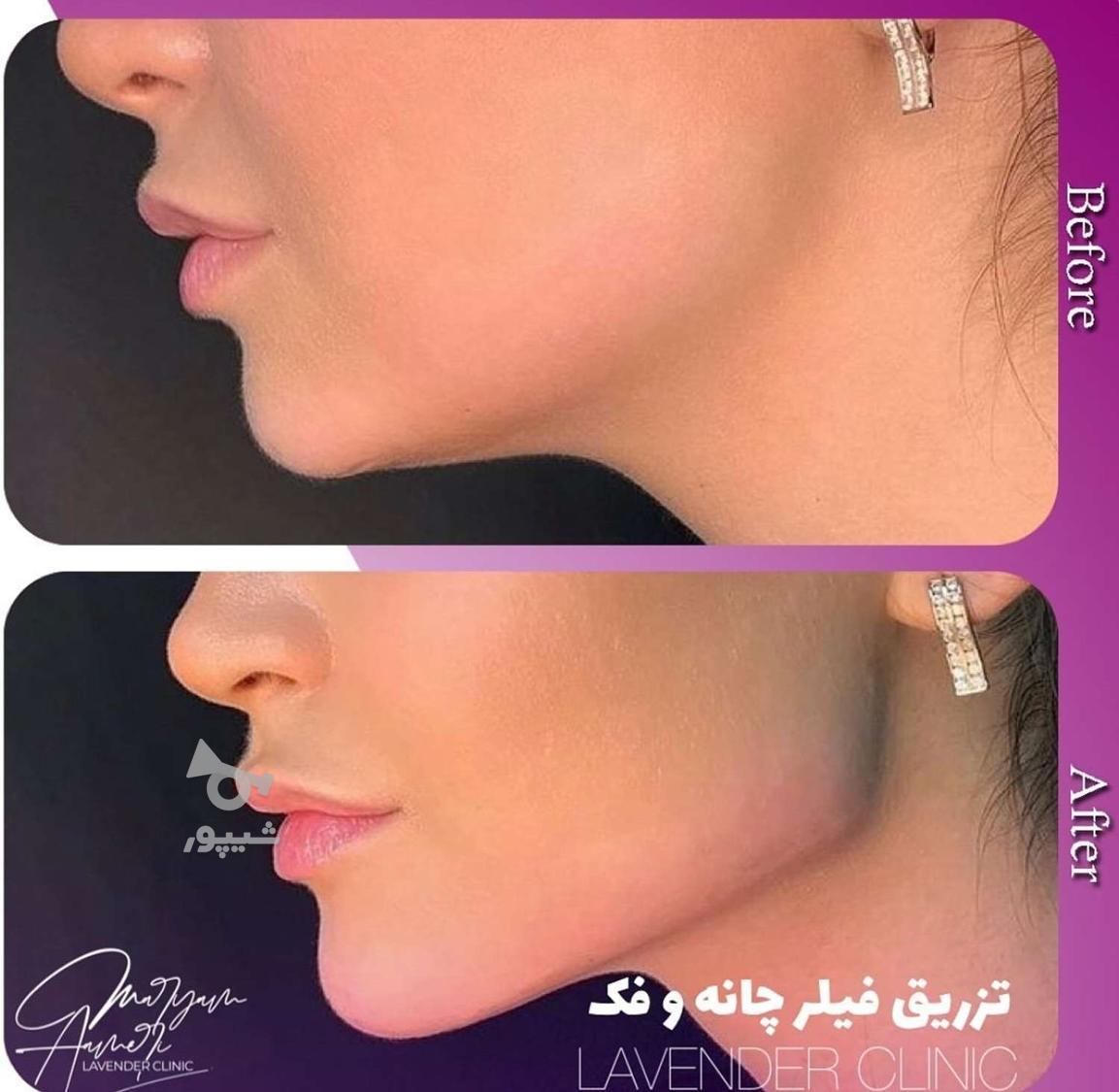جشنواره تابستانه ژل و بوتاکس|شرایط اقساطی