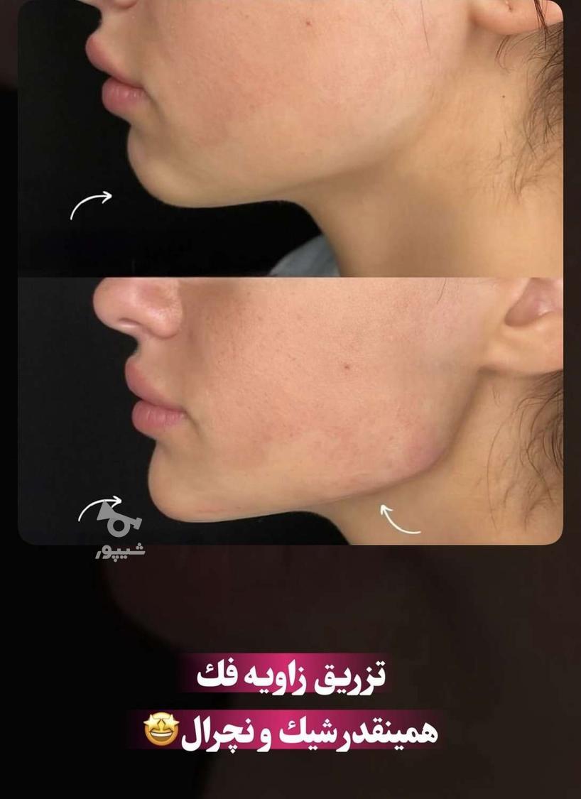 جشنواره تابستانه ژل و بوتاکس|شرایط اقساطی
