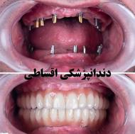دندانپزشکی زیبایی و لمینت قسط ایمپلنت