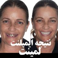 دندانپزشکی اقساط لمینت ایمپلنت و کلیه خدمات دندان