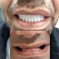 دندان مصنوعی/دندانسازی