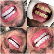 دندانپزشکی قرارداد با بیمه -اقساط / ایمپلنت لمینیت / عمومی