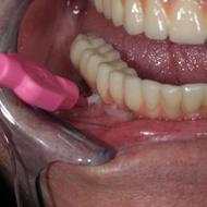 لمینیت / ایمپلنت / کامپوزیت قسطی کلیه خدمات دندان